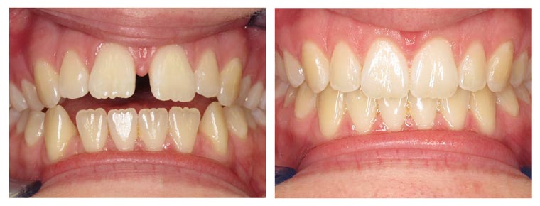 Invisalign dental transformation by Finksburg Dentl Associates